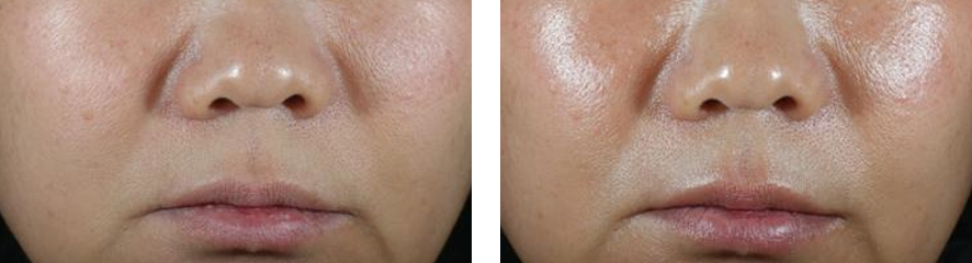 Resultados do tratamento na face